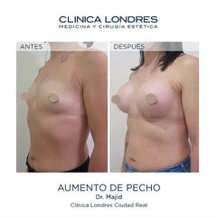 Aumento de pecho - Clínica Londres