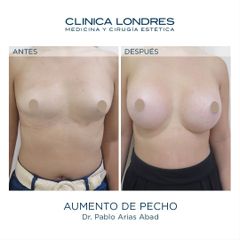 Aumento de pecho - Clínica Londres