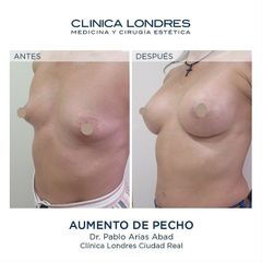 Aumento de pecho - Clínica Londres