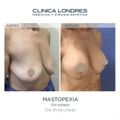 Mastopexia - Clínica Londres