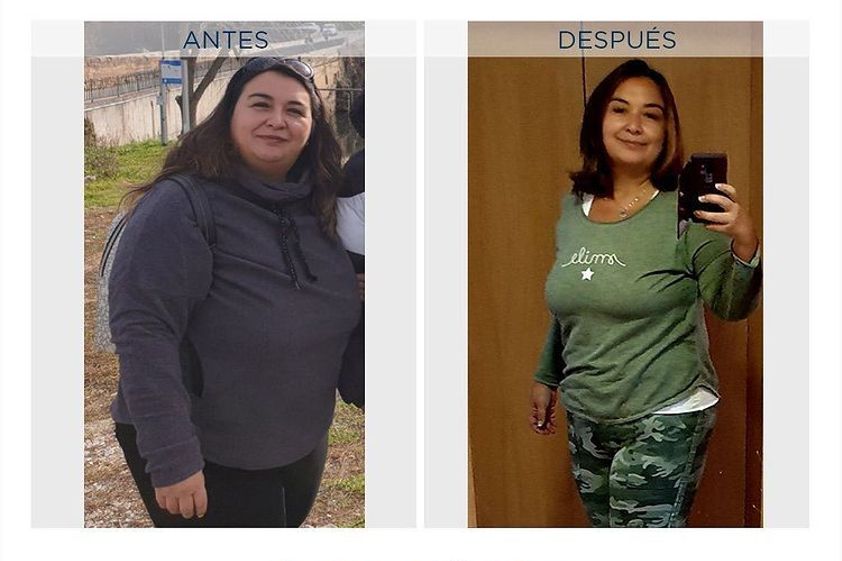 Banda gástrica antes y después - 791817