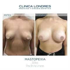 Mastopexia - Clínica Londres