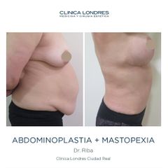 Abdominoplastia + Mastopexia - Clínica Londres