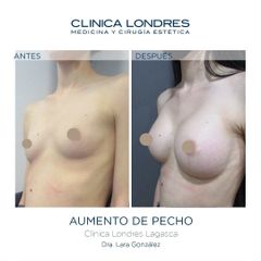 Aumento de pecho - Clínica Londres