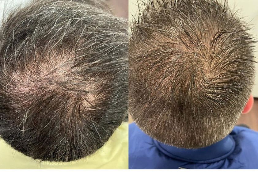Mesoterapia antes y después - 813614