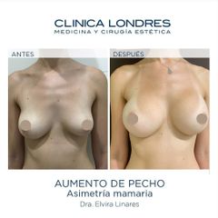 Aumento de pecho - Clínica Londres
