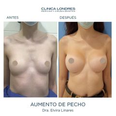Aumento de pecho - Clínica Londres