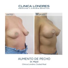Aumento de pecho - Clínica Londres