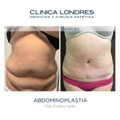 Abdominoplastia - Clínica Londres