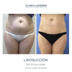 Liposucción - Clínica Londres
