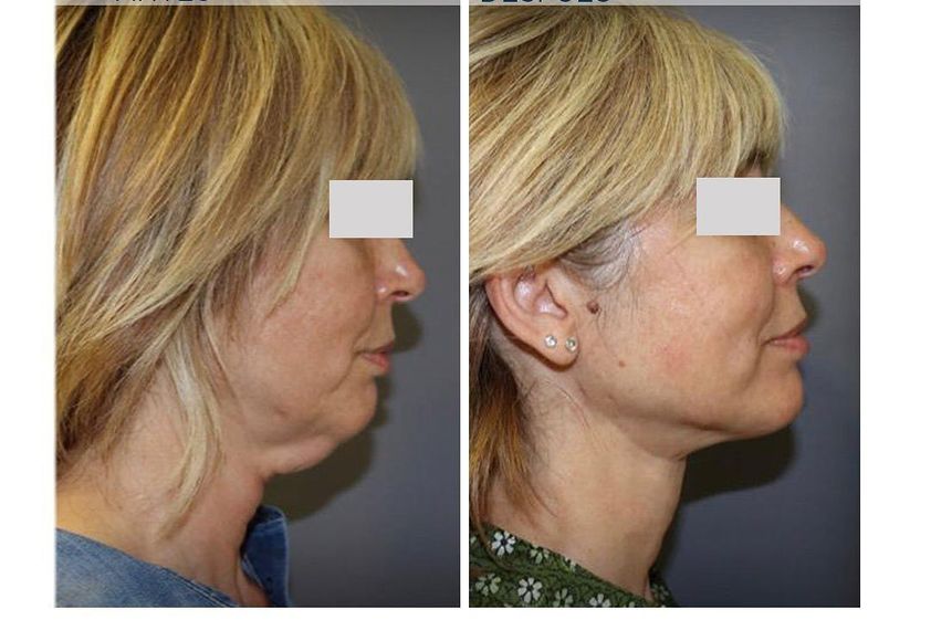 Liposucción de papada antes y después - 813639