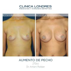 Aumento de pecho - Clínica Londres
