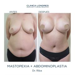 Mastopexia + Abdominoplastia - Clínica Londres