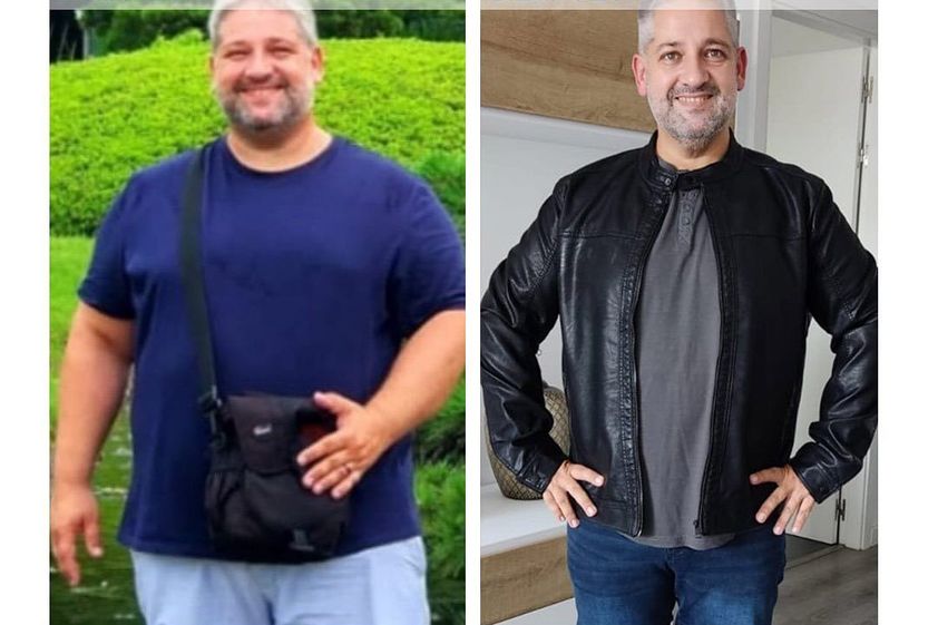 Reducción de estómago antes y después - 813644