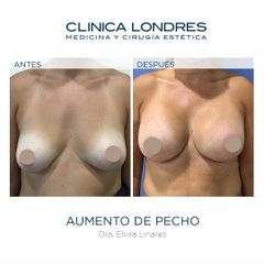 Aumento de pecho - Clínica Londres