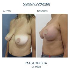Mastopexia - Clínica Londres