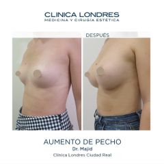 Aumento de pecho - Clínica Londres