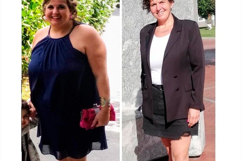 Reducción de estómago antes y después - 813658
