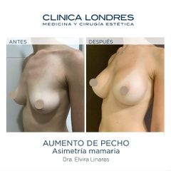 Aumento de pecho - Clínica Londres