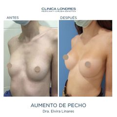 Aumento de pecho - Clínica Londres