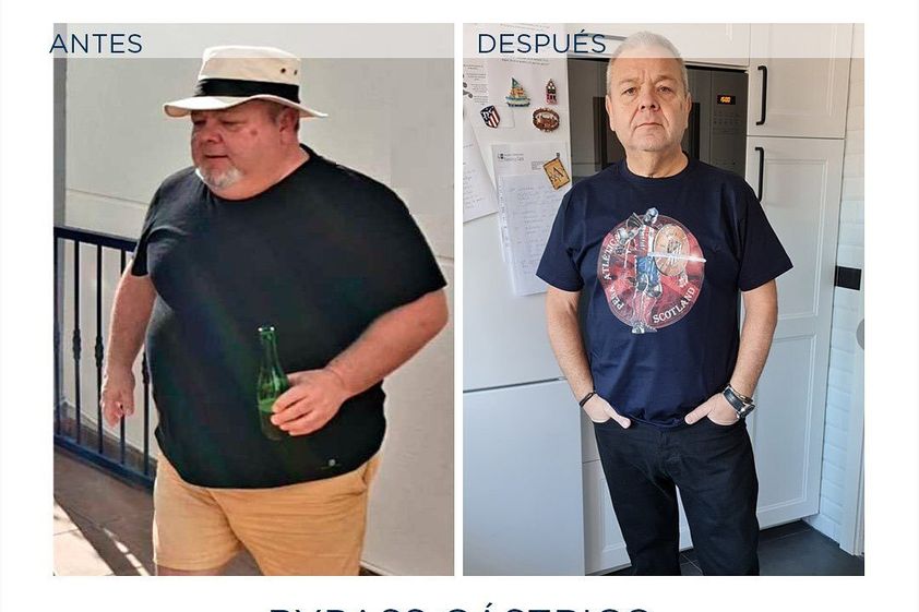 Reducción de estómago antes y después - 813667