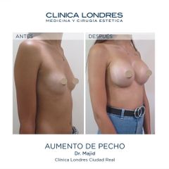 Aumento de pecho - Clínica Londres