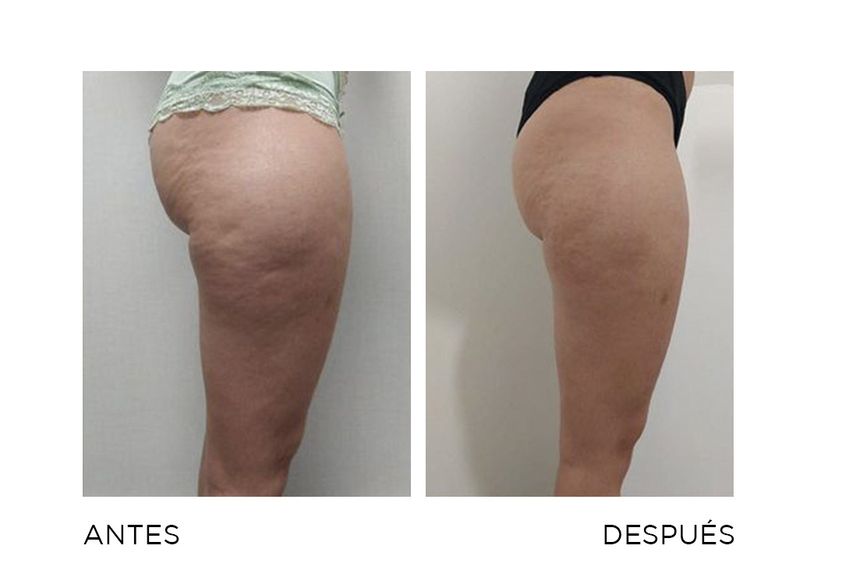 Celulitis antes y después - 860211