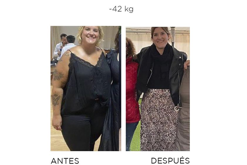 Reducción de estómago antes y después - 860222