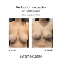 Reducción de pecho