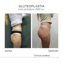 Gluteoplastia - Clínica Londres