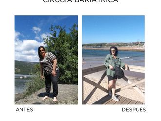 Manga gástrica antes y después - 860822