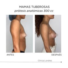 Mamas tuberosas - Clínica Londres