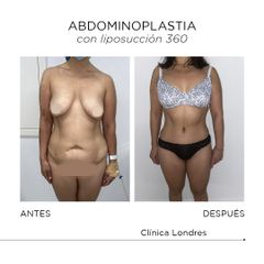 Abdominoplastia - Clínica Londres