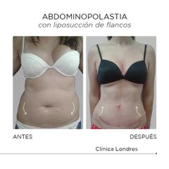 Abdominoplastia con liposucción de flancos
