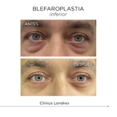 Blefaroplastia inferior