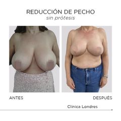 Reducción de pecho sin prótesis - Clínica Londres