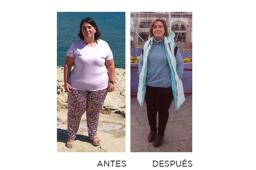 Reducción de estómago antes y después - 863245