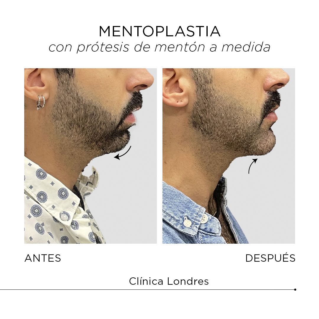 Aumento mentón Antes y después - Multiestetica.com - Multiestetica.com