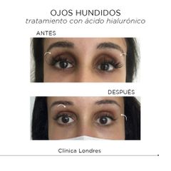 Tratamiento para ojos hundidos con ácido hialurónico - Clínica Londres