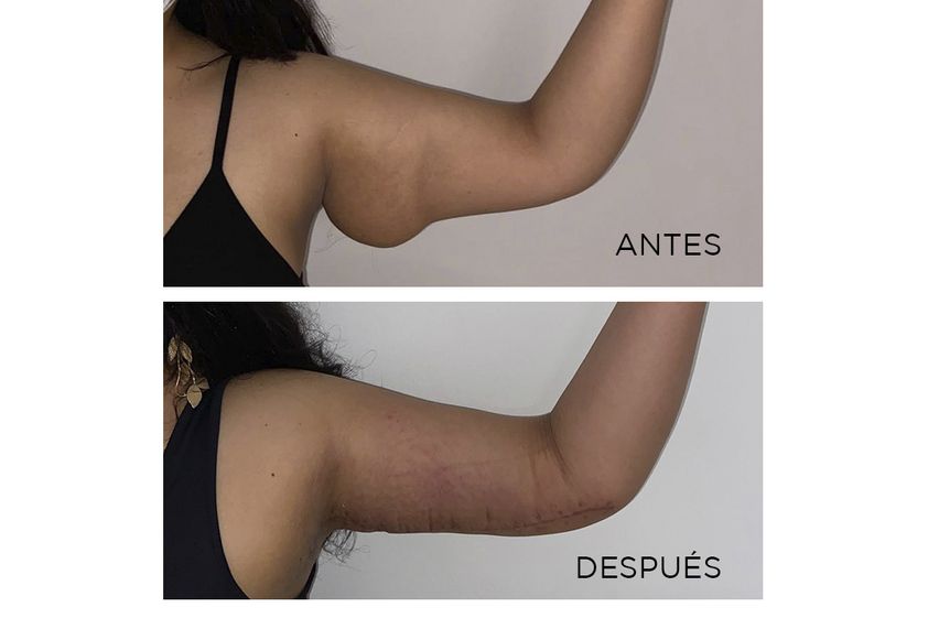 Liposucción antes y después - 863750