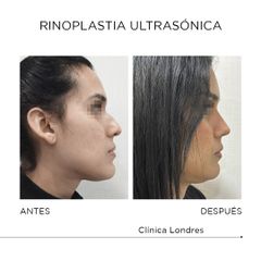 Rinoplastia ultrasónica - Clínica Londres