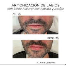 Armonización labial con ácido hialurónico - Clínica Londres