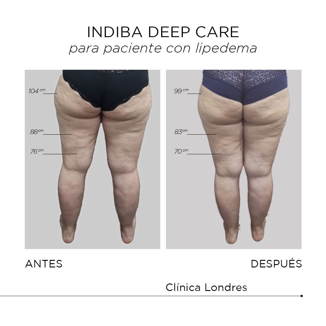 Drenaje linfático Antes y después - Multiestetica.com - Multiestetica.com