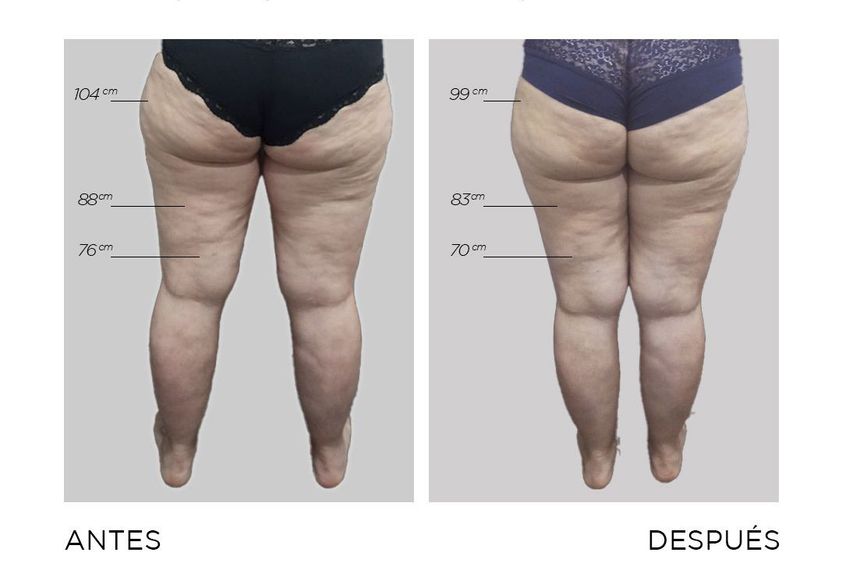 Drenaje linfático antes y después - 865047