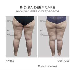 Indiba Deep Care - Clínica Londres