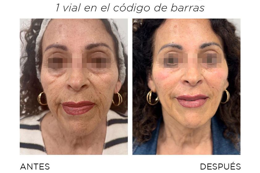 Rellenos faciales antes y después - 865417