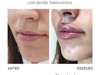Aumento labios - 865813