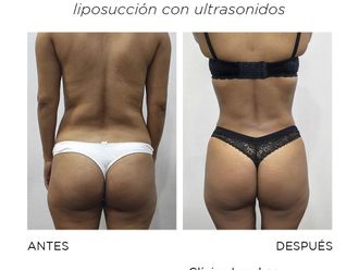 Lipo Vaser antes y después - 867191