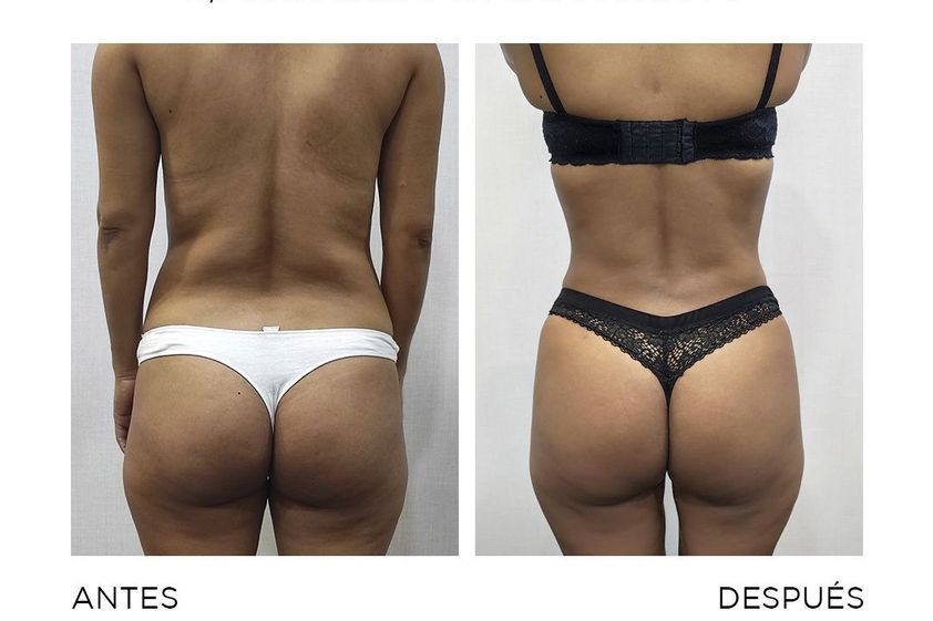 Lipo Vaser antes y después - 867191
