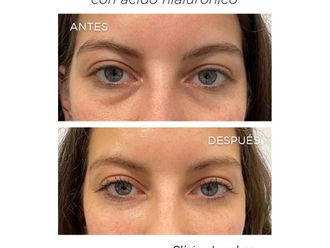 Eliminación ojeras antes y después - 867265